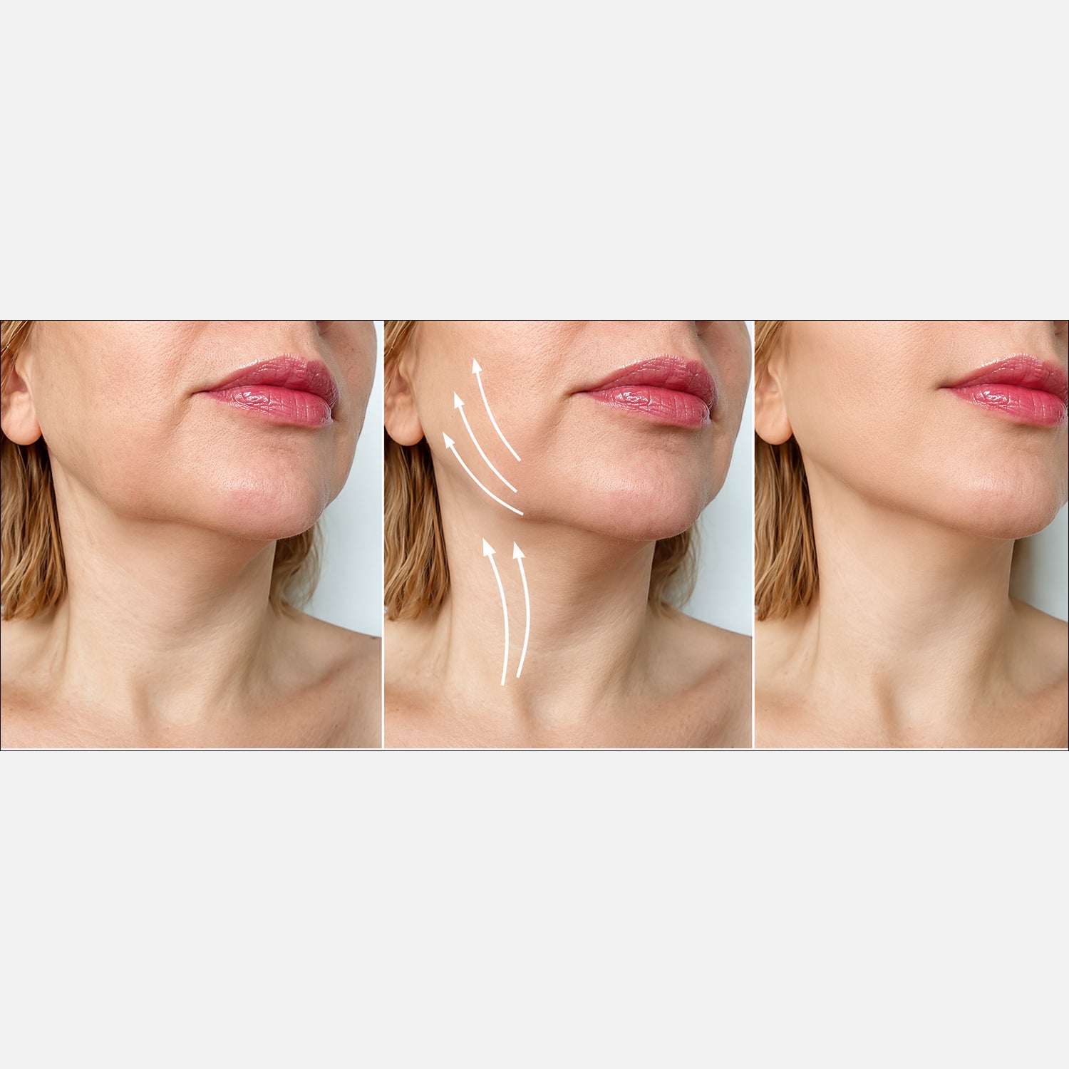Last in Stock: Chin Fit Elite with Photon Face-Lifting Technology &amp; Infrared, RED &amp; BLUE Light for Double Chin &amp; Jawline 8421313 6