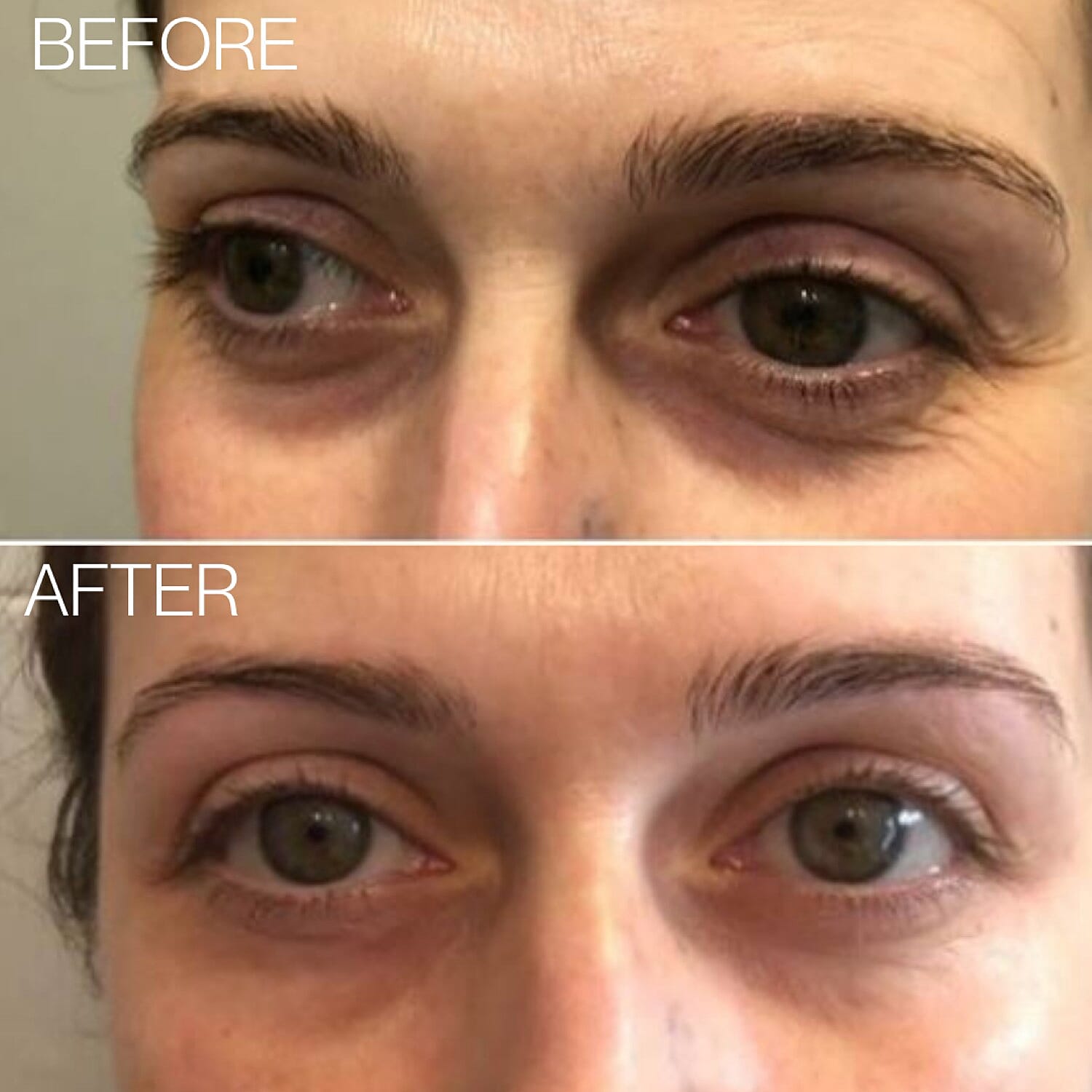 Beautical Microneedle Eye Patches 8127038 5
