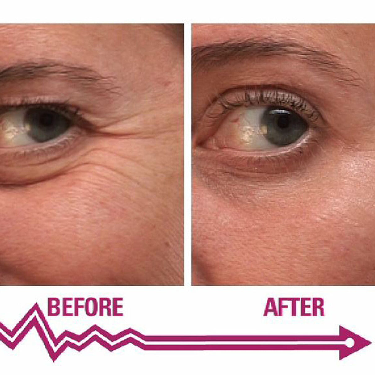 SKINEANCE Wrinkle Filler - Fills and Smoothes Fine Lines &amp; Wrinkles Immediately - 15ml 8149180 2