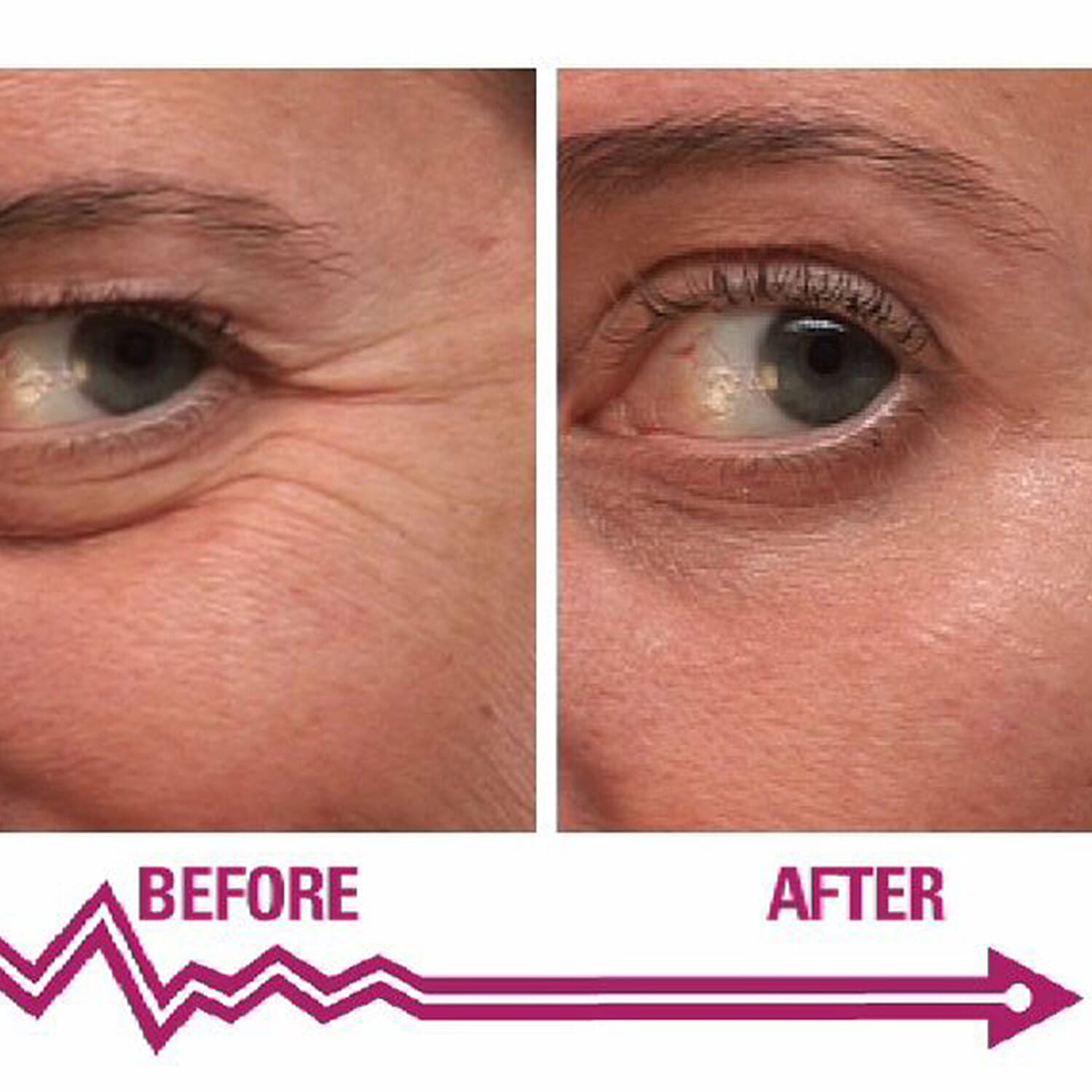 SKINEANCE Wrinkle Filler - Fills and Smoothes Fine Lines &amp; Wrinkles Immediately - 15ml 8149180 2