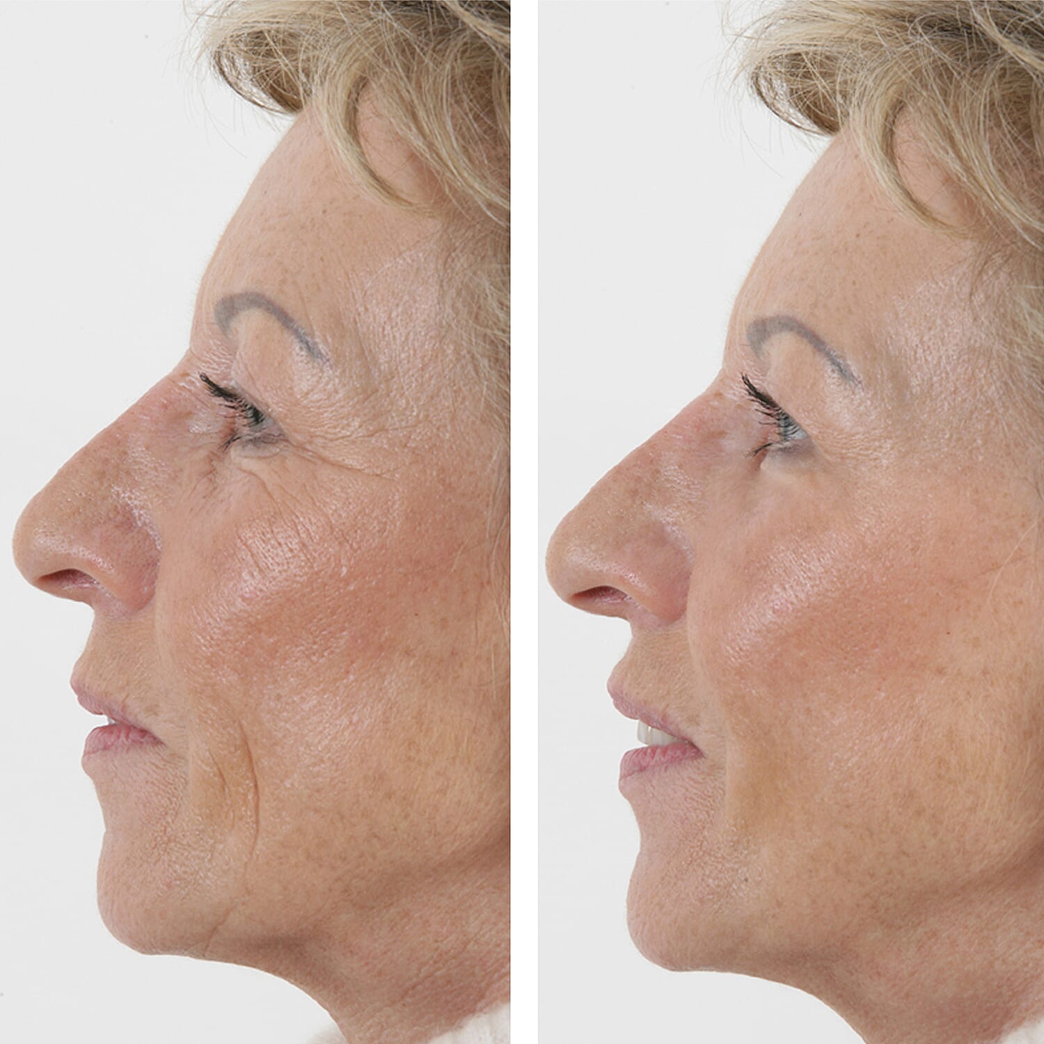 SKINEANCE Wrinkle Filler - Fills and Smoothes Fine Lines &amp; Wrinkles Immediately - 15ml 8149180 4